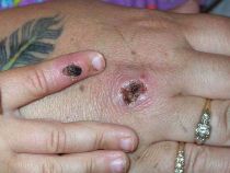 Monkeypox lesions